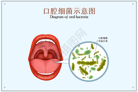 细菌引发口臭口腔医学配图图片