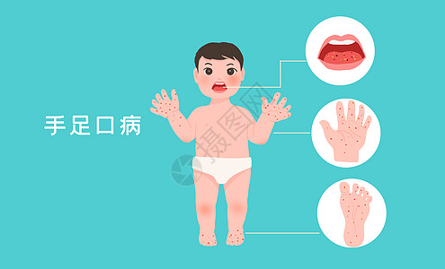 儿童手足口病高清图片