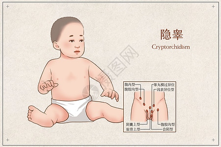 隐睾医疗插画图片