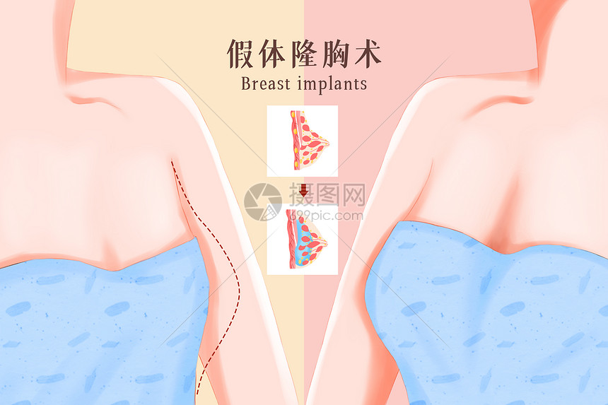 美容整形之假体隆胸插画图片