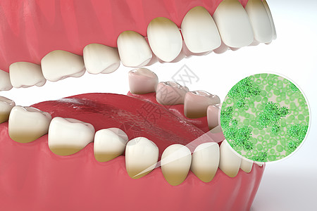 牙周炎场景口腔细菌高清图片