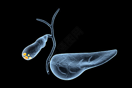 胆囊结石人体结构高清图片