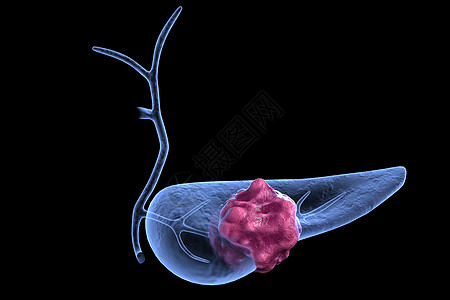 胰腺肿瘤模型背景图片
