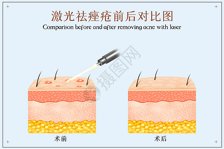 激光祛除痤疮示意图图片