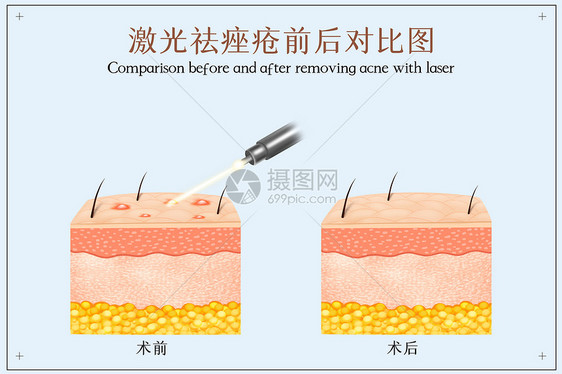 激光祛除痤疮示意图图片