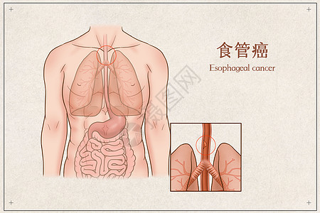 食管癌医疗插画图片