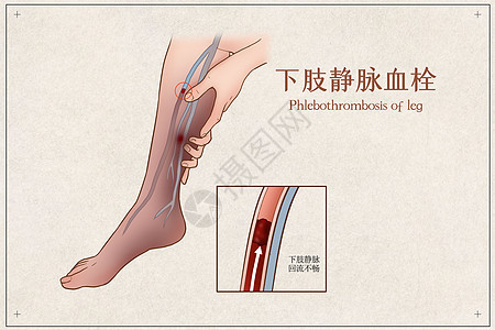 下肢静脉血栓医疗插画背景图片