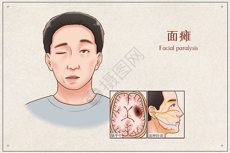 卤水面面瘫医疗插画插画