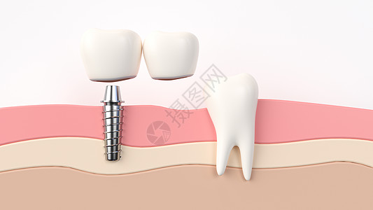 创意种植牙牙矫正素材高清图片