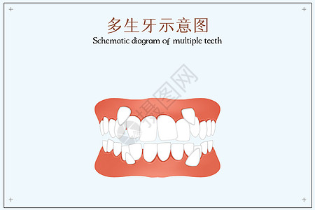 多生牙示意图口腔医学插图图片