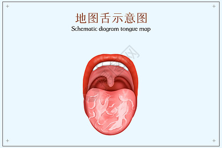 地图舌示口腔医学配图高清图片