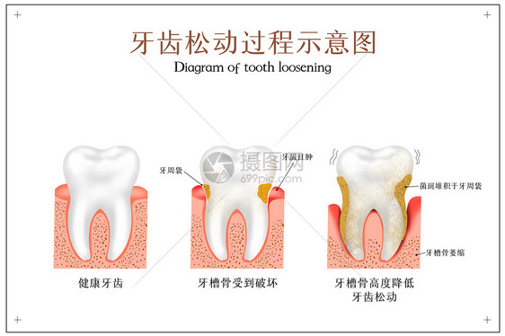牙齿松动过程牙科配图图片