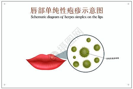 口腔单纯性疱疹口腔医学插图图片