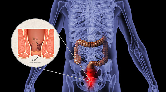 人体痔疮场景图片