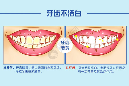 洗牙口腔医学插图图片