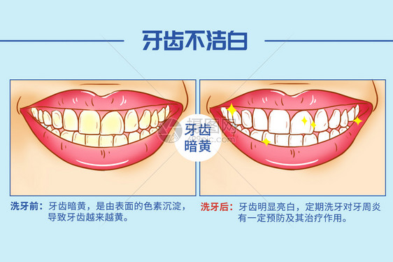 洗牙口腔医学插图图片