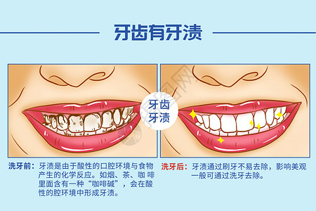 水润亮白洗牙口腔医学插图插画