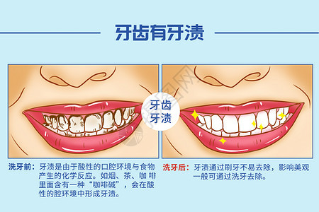 洗牙口腔医学插图图片