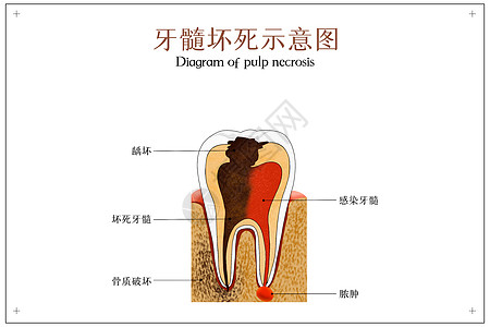 牙髓坏死医疗配图高清图片
