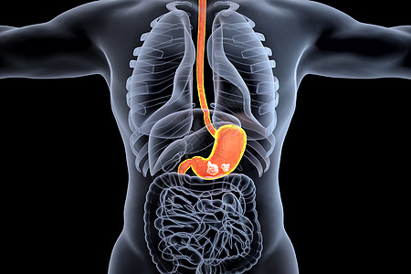 胃部肿瘤场景图片
