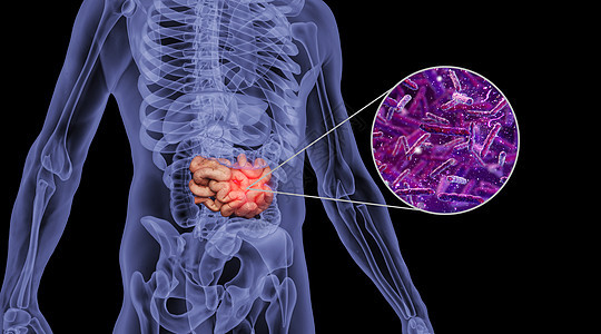 人体肠癌场景图片