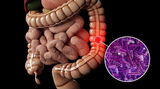 人体肠癌场景图片