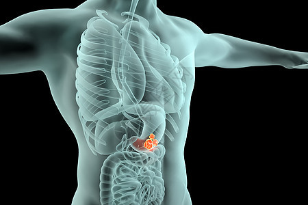 胃部肿瘤场景背景图片