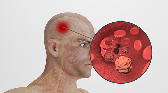 头疼的人人体脑动脉瘤场景设计图片