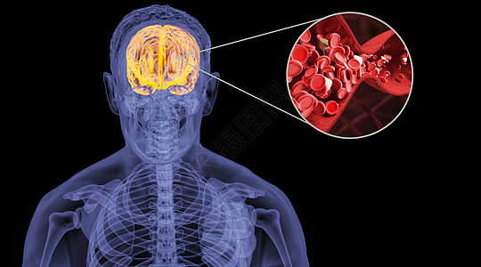 脂肪人体脑淤血设计图片
