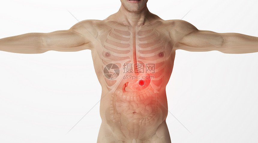 人体胃癌场景图片