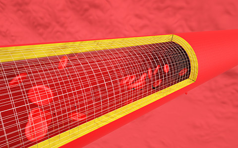 血管支架血管支架高清图片