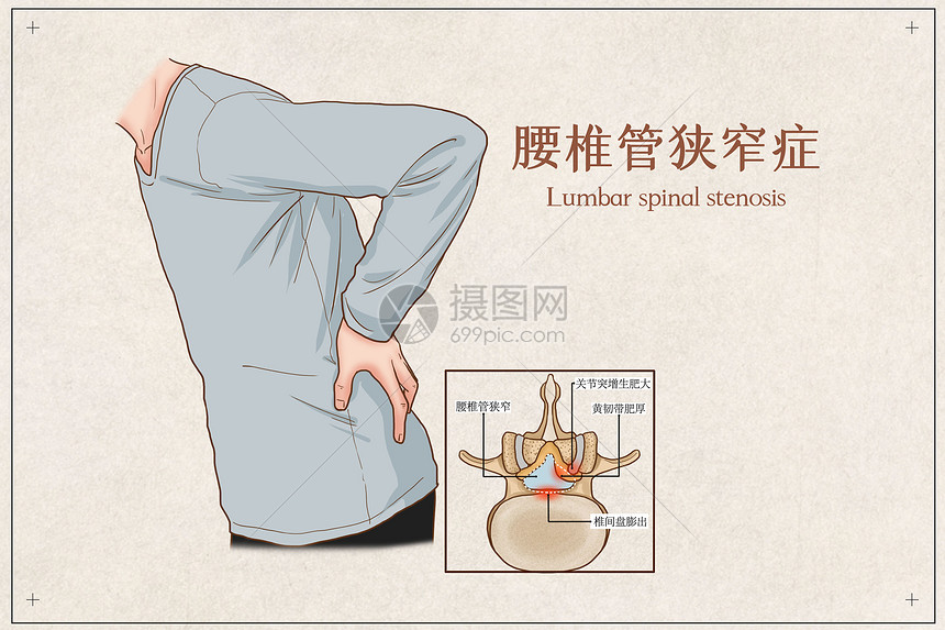 腰椎管狭窄症医疗插画图片