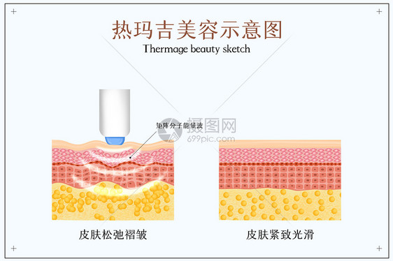 热玛吉美容紧致肌肤示意图图片