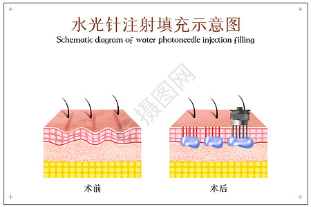 美肤水光针注射美容医美配图插画