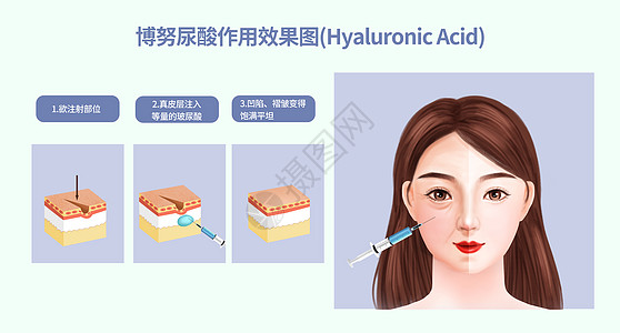 去皱玻尿酸作用效果图插画