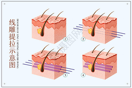 线雕提升面部医美配图背景图片
