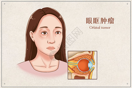 眼眶肿瘤医疗插画高清图片