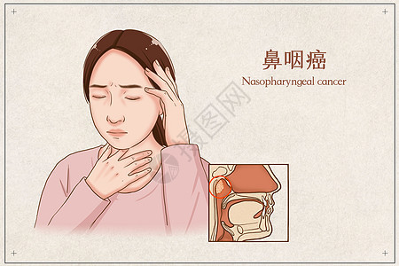 鼻咽癌医疗插画图片