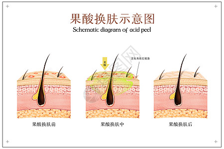 老化肌肤果酸换肤医美配图插画