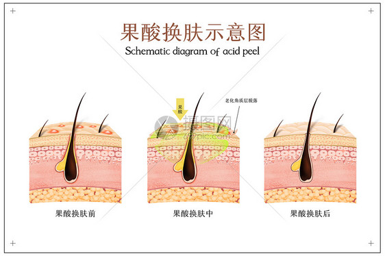 果酸换肤医美配图图片
