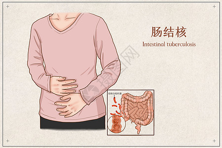 肠结核医疗插画图片