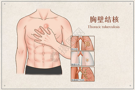 胸壁结核医疗插画生病高清图片素材