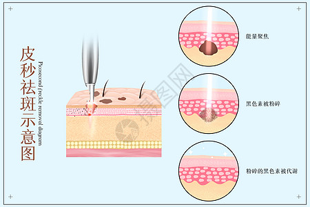 皮秒祛斑医美配图高清图片