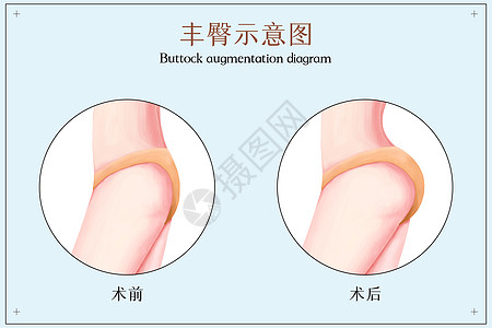 丰臀前后医美配图图片