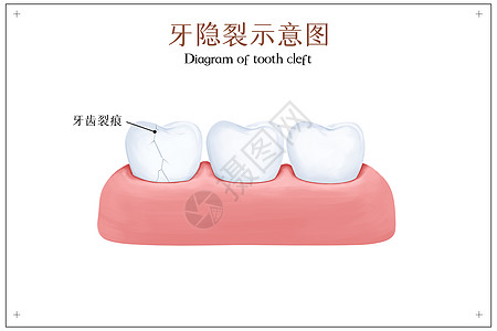 牙隐裂示意图图片