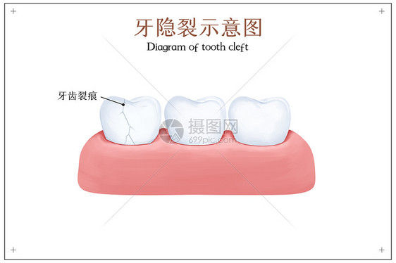 牙隐裂示意图图片