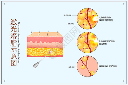激光溶脂医美配图高清图片