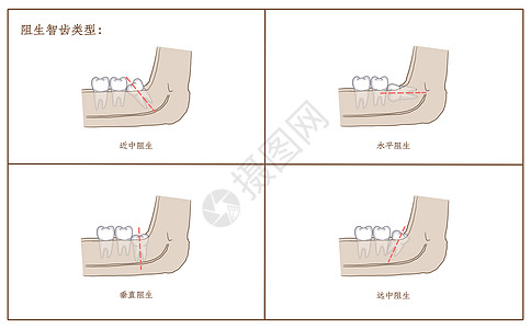 阻生智齿类型图片