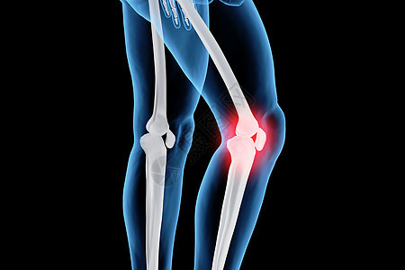 C4D膝盖疾病图片