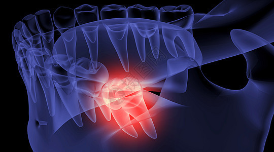 口腔智齿疼痛图片